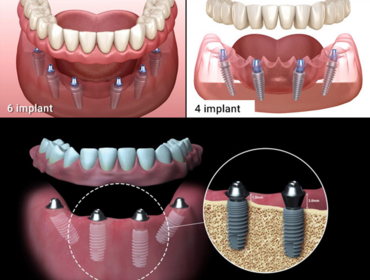 Everything You Need to Know Before Full-Arch Dental Implant Treatment