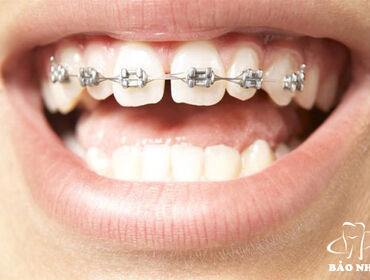 When Do You Need Orthodontic Braces? A Complete Guide to Achieving a Beautiful Smile